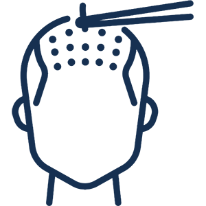 Greffe de cheveux FUE